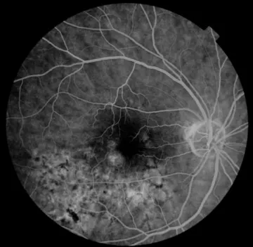 OCT retinal scan